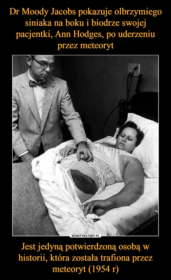 Dr Moody Jacobs pokazuje olbrzymiego siniaka na boku i biodrze swojej pacjentki, Ann Hodges, po uderzeniu przez meteoryt Jest jedyną potwierdzoną osobą w historii, która została trafiona przez meteoryt (1954 r)