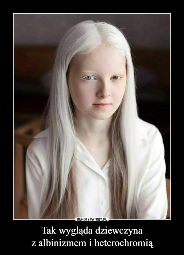 Tak wygląda dziewczynaz albinizmem i heterochromią –  